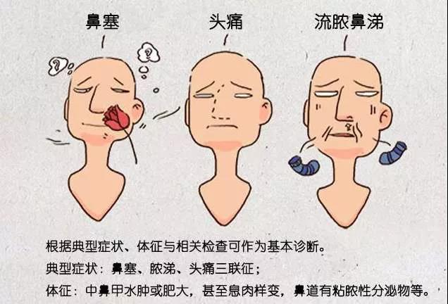 鼻窦炎