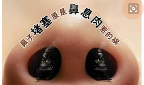重庆鼻息肉