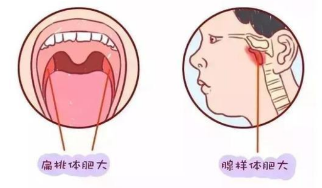 扁腺体肥大