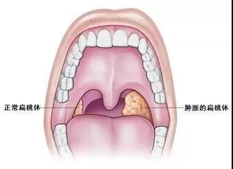 扁桃体炎