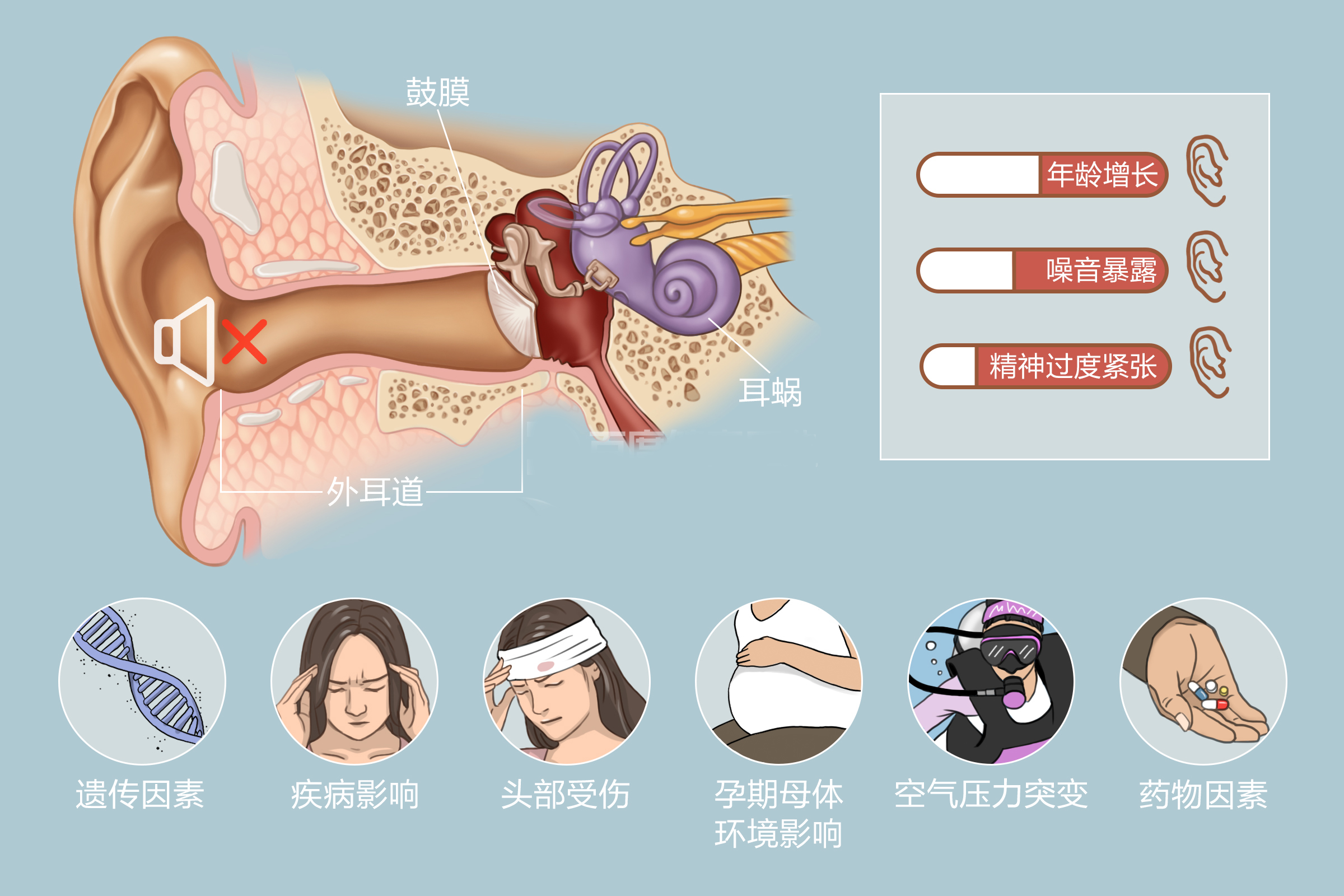 神经性耳聋