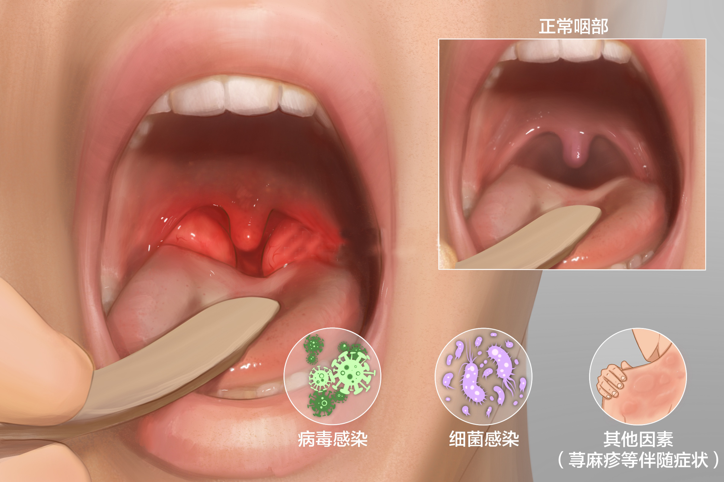咽喉炎