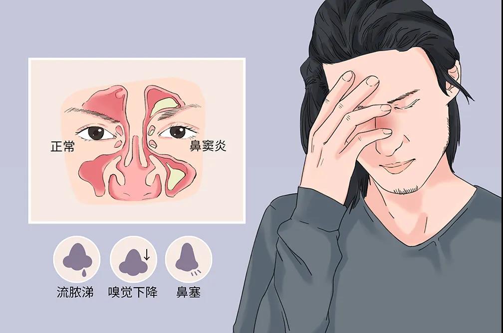 鼻窦炎的症表现