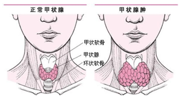 甲状腺肿大