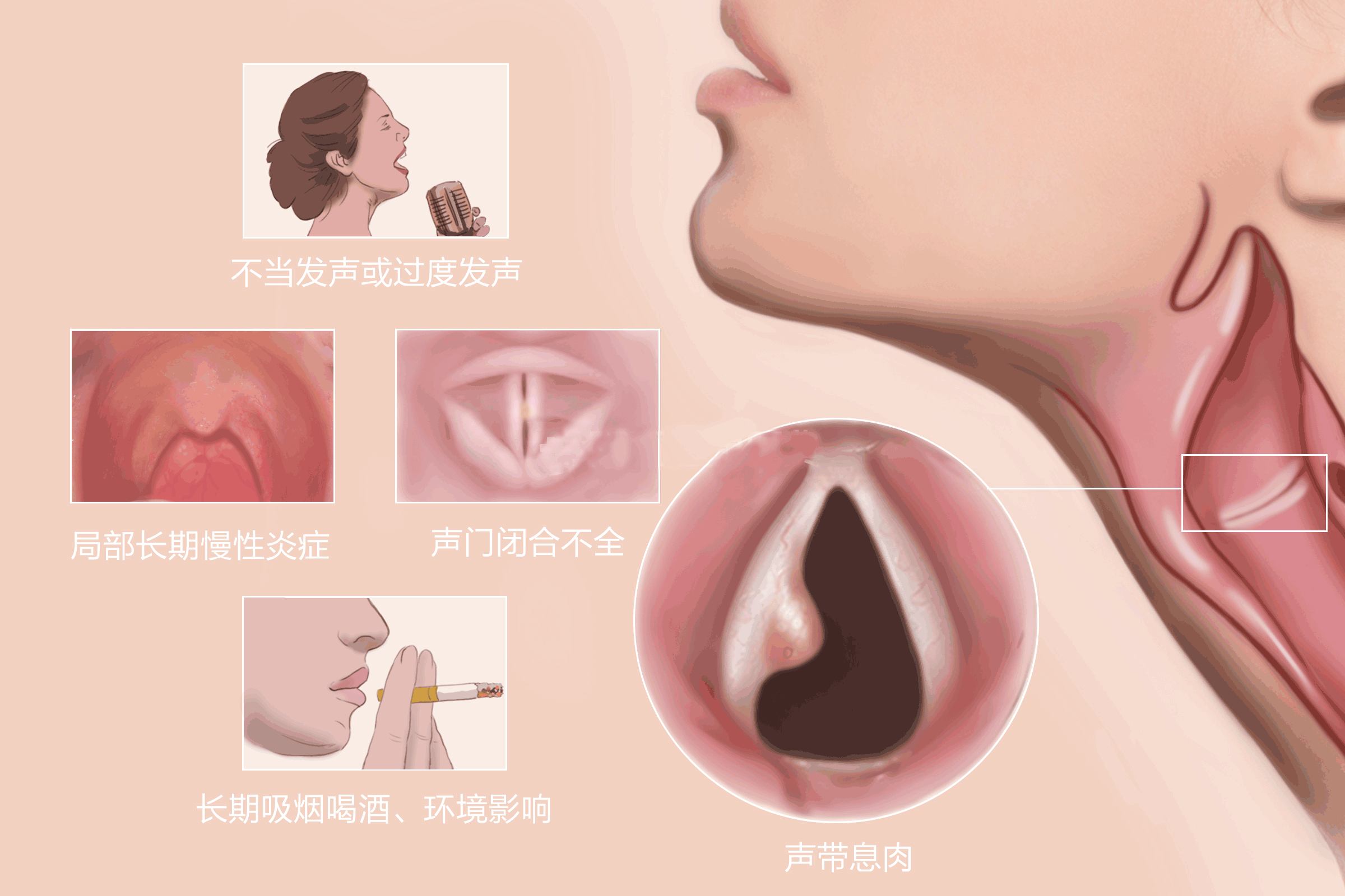 声带息肉的症状