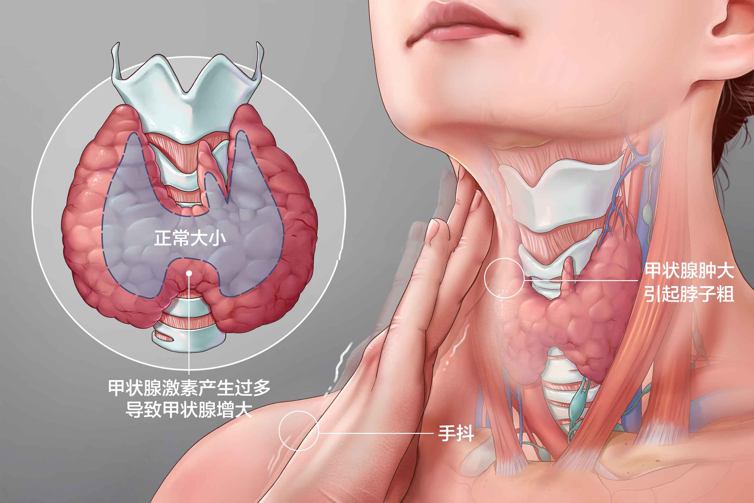 甲亢的治疗