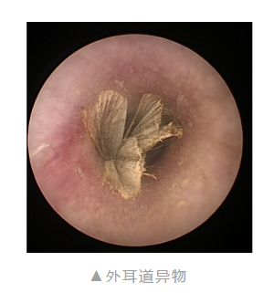 外耳道异物